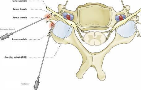 Medial bransch (MB) 8 Navn