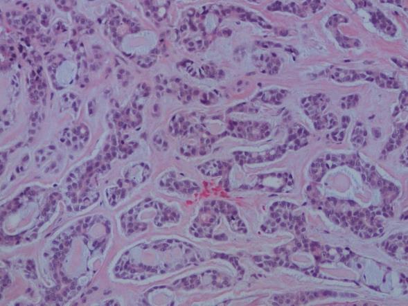 Basal cell adenocarcinoma Sebaceous carcinoma Salivary duct carcinoma Squamous cell carcinoma Small cell carcinoma And 12 other carcinoma types (total 24 entities) Adenoid cystic carcinoma