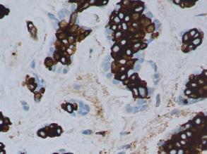 lavgradig adenokarsinom (og solid variant av Adenoid cystisk karsinom) Fra: RooperL et al