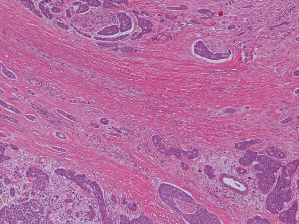 Fjernet tumor i munngulv og utført halsdisseksjon regio 1b+ 2a ve side Clear cell carcinoma