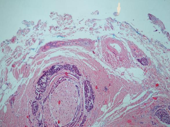 It has a squamoid phenotype and lacks features of other clear cell-rich salivary gland