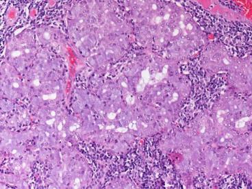 malignant salivary gland neoplasm composed of