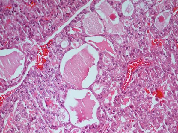 Secretory carcinoma Secretory