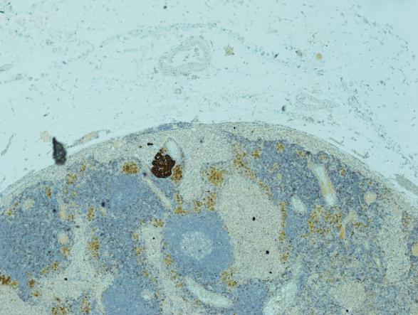Mikroskopisk lymfeknute metastase IHC AE1-AE3 Mammaanalogt sekretorisk karsinom (syn) -Definert med ETV6 translokasjon i 2010 (prof A Skalova, Praha ) -Tidligere var disse kasus klassifisert som