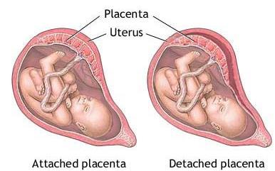 ABRUPTIO PLACENTA Løsning av placenta fra uterinveggen, delvis eller helt Forekomst ; i 1-2 % av alle