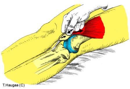 5.31 Patellarfemoral glidetest Fig 101.