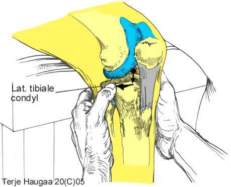 6.2 Laterale tibiale platå T. Haugaa Fig 105.