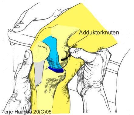 6.16 Lokalisering av adduktorknuten T.