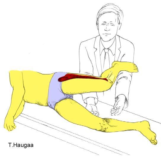 8.29 Resultatet av en positiv Ober test Fig 161. Ober test brukes til å vurdere kontraksjonen til M.tensor fasciae latae og tracktus iliotibialis. Abduser foten og flekter kneet til 90º.