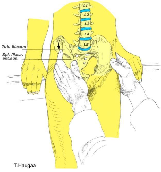 8.31 Palpasjon av Tuberculum Iliacum Fig 163.