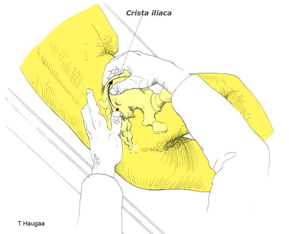 8.35 Palpasjon av Crista Iliaca, og Tuberculum Iliacum Fig 166.