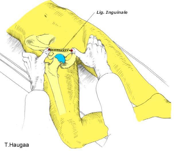 8.39 Lokalisering av Lig. Inguinale Fig 170.
