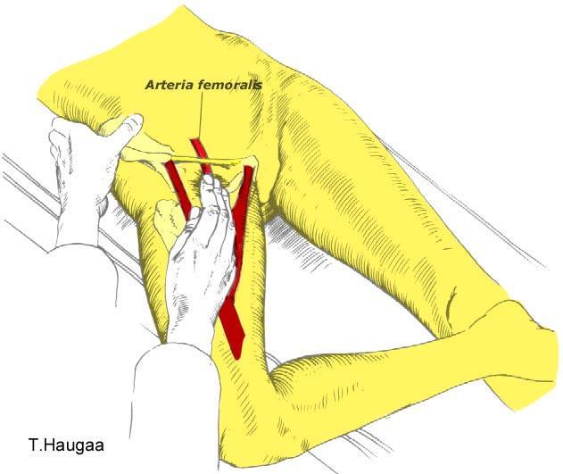 8.40 Lokalisering av Arteria Femoralis Fig 171.