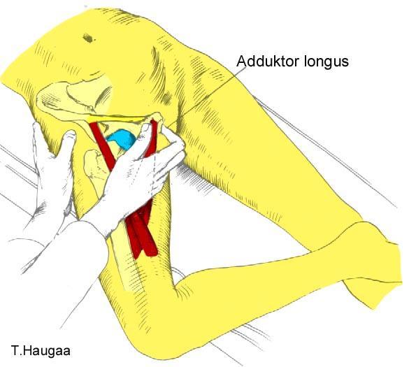 8.43 Palpasjon av M. adduktor longus Fig 174.