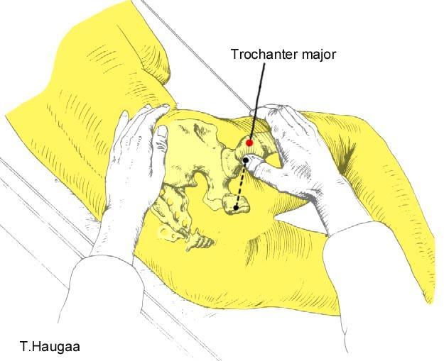 8.46 Lokalisering av Trochanter major Fig 177.