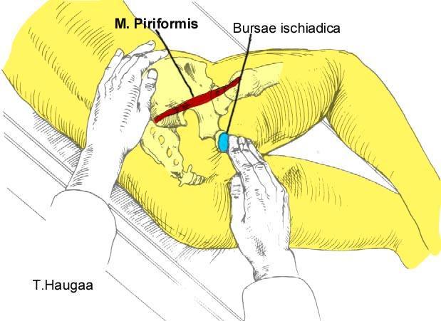 8.47 Palpasjon av M. piriformis og Bursae Ischiadica Fig 178.