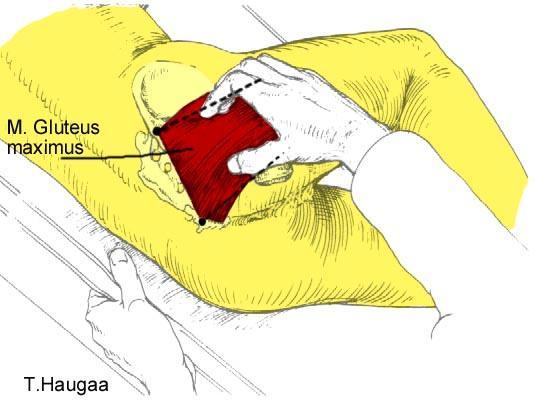 8.52 Palpasjon av utspringet til M. Gluteus maximus Fig 183.