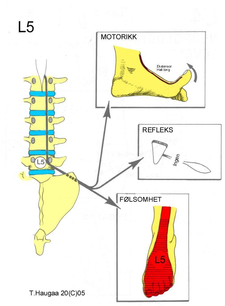 9.2 Nevrologisk nivå L5 T. Haugaa Fig 185.