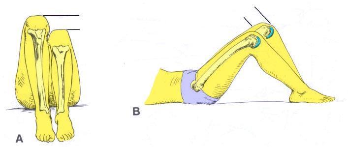 10. Noen praktiske undersøkelser 10.1 Måling av femoral eller tibial beinlengdeforskjell Fig 195. Måling av femoral eller tibial beinlengdeforskjell. A.