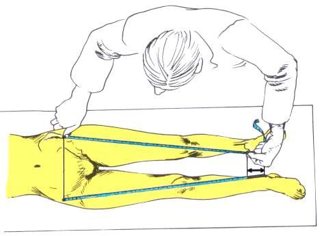 10.2 Måling av faktisk beinlengdeforskjell Fig 196. Måling av faktisk beinlengdeforskjell. Mål fra referansepunkt i hoften til den mediale malleol.