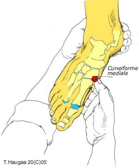 4.3 Cuneiforme mediale. T. Haugaa Fig 035. Før tommelen proksimalt langs 1.te metatarsalknokkel.