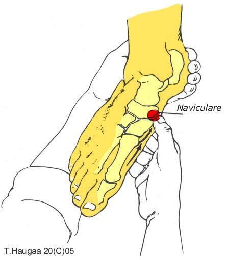 4.4 Os naviculare. T. Haugaa Fig 036. Før tommelen proksimalt fra cuneiforme mediale.