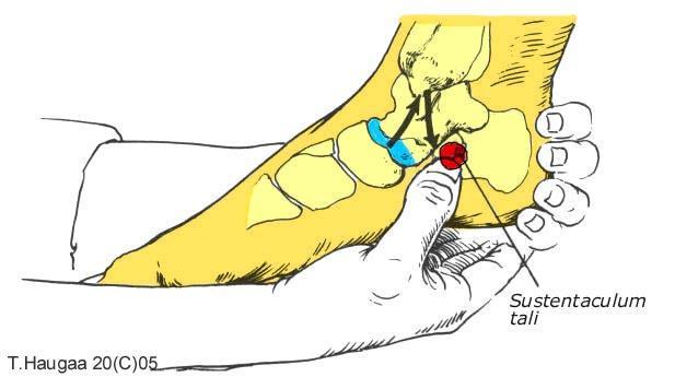 4.8 Sustentaculum tali. T. Haugaa Fig 040. Mediale malleolus referansepunkt.