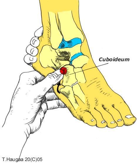 4.13 Os cuboideum T. Haugaa Fig 045. Når du har lokalisert tuberositas 5.met.