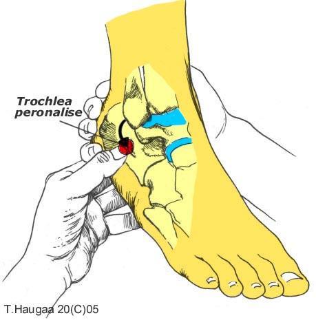 4.15 Trochlea peronalise T. Haugaa Fig 047. Et lite fremspring.