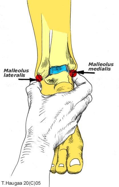 4.17 Malleolus lateralis og malleolus medialis T. Haugaa Fig 049.