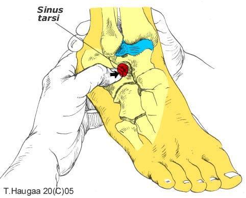 4.20 Sinus tarsi T. Haugaa Fig 052.