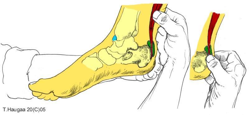 4.36 Bursae tendinis calcanei (akilles) T. Haugaa Fig 068.