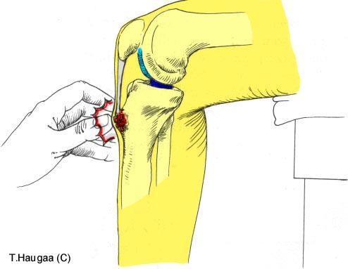 5.8 Osgood-Schlatter syndrom T. Haugaa Fig 078.