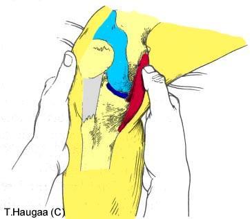 5.11 Palpasjon av mediale collaterale ligament Fig 081.