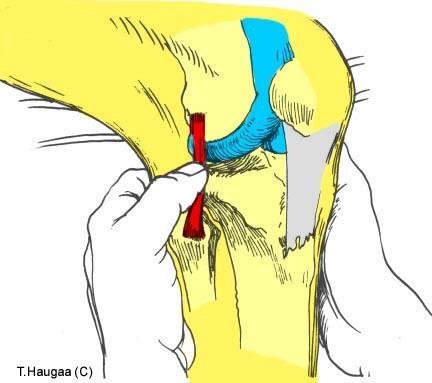 5.15 Palpasjon av laterale collaterale ligament Fig 085.