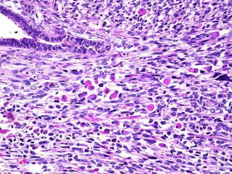 Embryonalt Rhabdomyosarcom / Sarcoma Botryoides RMS som