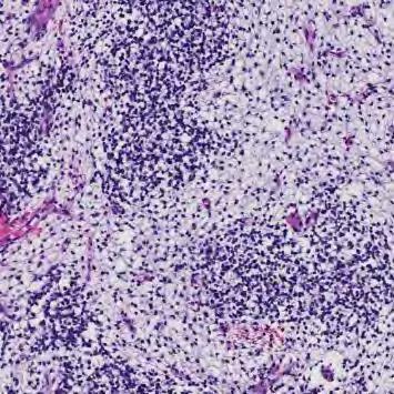 Embryonalt Rhabdomyosarcom / Sarcoma Botryoides RMS som komponent Carcinosarcom/MMMT Adenosarcom Heterologt