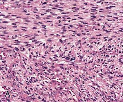 Embryonalt Rhabdomyosarcom / Sarcoma Botryoides RMS som komponent Carcinosarcom/MMMT Adenosarcom Heterologt element Embryonalt RMS