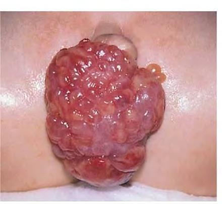 Embryonalt Rhabdomyosarcom / Sarcoma Botryoides