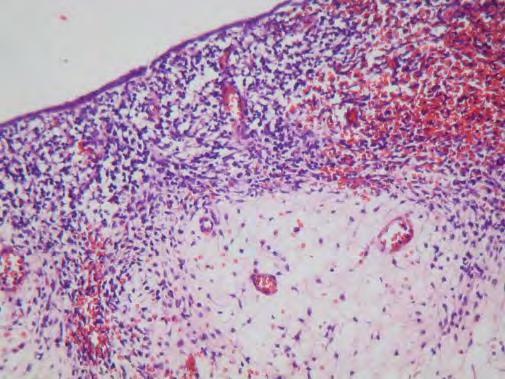 Embryonalt Rhabdomyosarcom / Sarcoma Botryoides