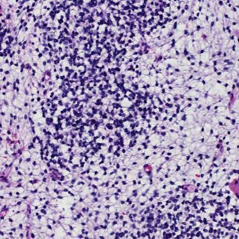 Embryonalt Rhabdomyosarcom / Sarcoma Botryoides Udifferensierte celler Små, ovale, hyperkromate kjerner Lite cytoplasma 2-12 mitoser/10hpf Dette er IKKE