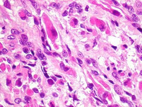 Embryonalt Rhabdomyosarcom / Sarcoma Botryoides Udifferensierte celler Små, ovale, hyperkromate kjerner Lite cytoplasma 2-12 mitoser/10hpf Dette er IKKE