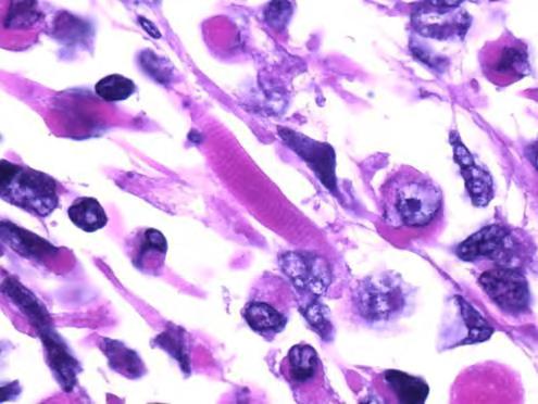 Embryonalt Rhabdomyosarcom / Sarcoma Botryoides Udifferensierte celler Små, ovale, hyperkromate kjerner Lite cytoplasma 2-12 mitoser/10hpf Dette er IKKE