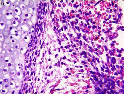 Embryonalt Rhabdomyosarcom / Sarcoma Botryoides Udifferensierte celler Små, ovale, hyperkromate kjerner Lite cytoplasma 2-12 mitoser/10hpf Dette er IKKE
