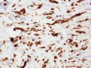 Embryonalt Rhabdomyosarcom / Sarcoma Botryoides Desmin, MSA Rhabdo OG leio Moden muskulatur Høyt og lavt differensierte Ikke