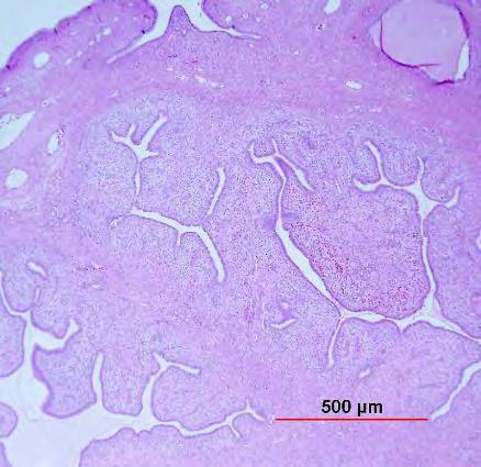 Differensialdiagnoser Adenosarcom Epidemiologi Unge voksne kvinner Makroskopisk Polypp Mikroskopisk Benignt epitel + Malignt stroma Periglandulær hypercellularitet