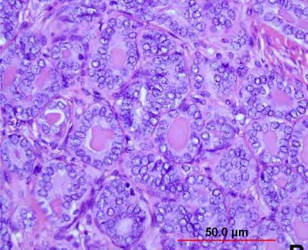 Mesonefrisk carcinom Tubulært Eosinofilt hyalint materiale Duktalt