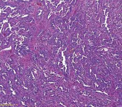 Differensialdiagnoser Andre carcinomer «Usual» adenocarcinoma