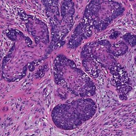 Adenoid Basalt Carcinom Kjerteldifferensiering Plateepiteldifferensiering Eventuelt