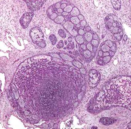 Differensialdiagnoser Adenoid basal hyperplasi Overfladisk (<1 mm)